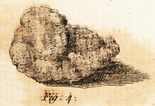 Account of a Calculus Extracted from a Cyst in the Neck.