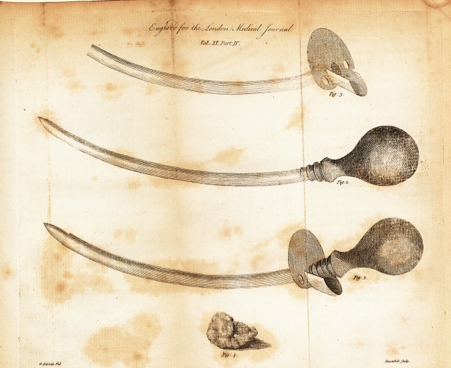 Account of a Calculus Extracted from a Cyst in the Neck.