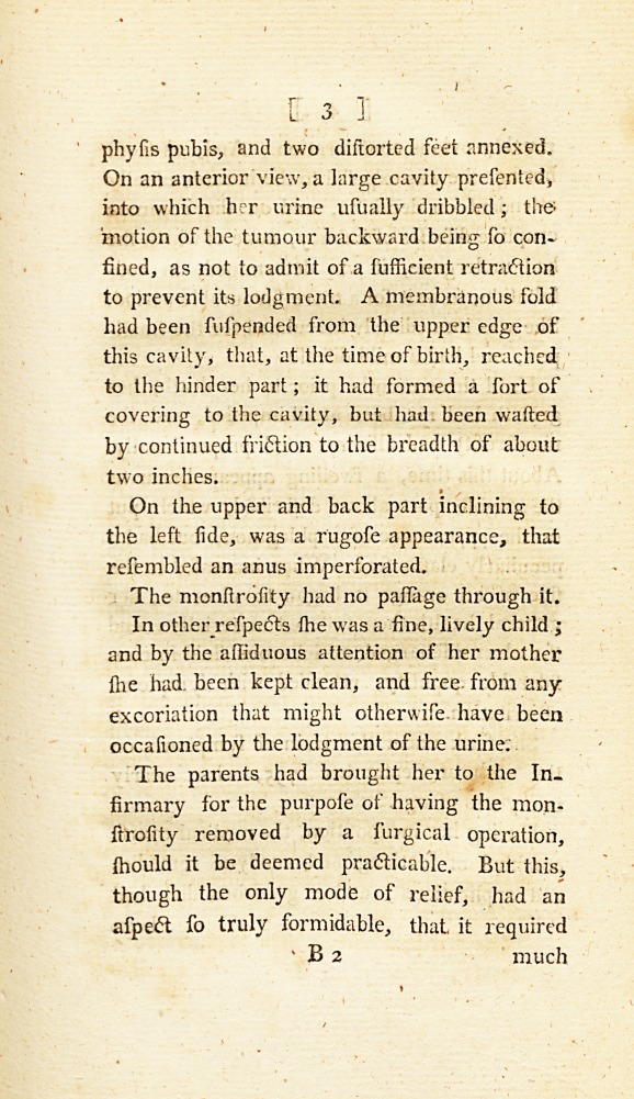 A Case of Monstrosity in a Child; with Physiological Remarks.