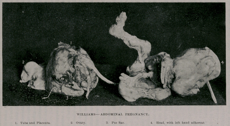 Report of a Recent Case of Abdominal Pregnancy, Complicated with Pyosalpinx,-Laparatomy, Recovery.