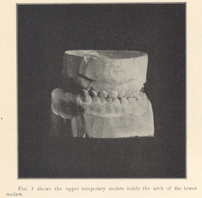 The Influence, on Development, of Arranging Irregularly Placed Teeth into Normal Positions.