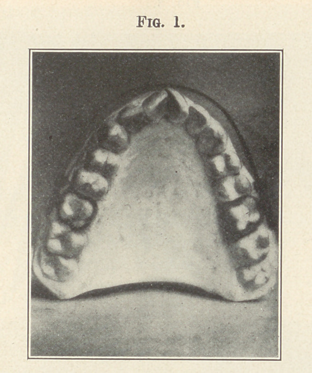 A Consideration of the Occlusal Balance.