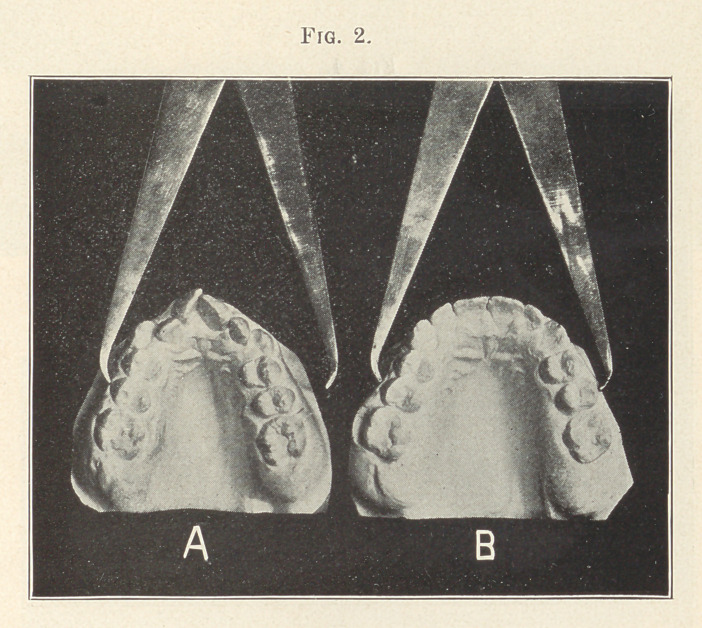 A Consideration of the Occlusal Balance.