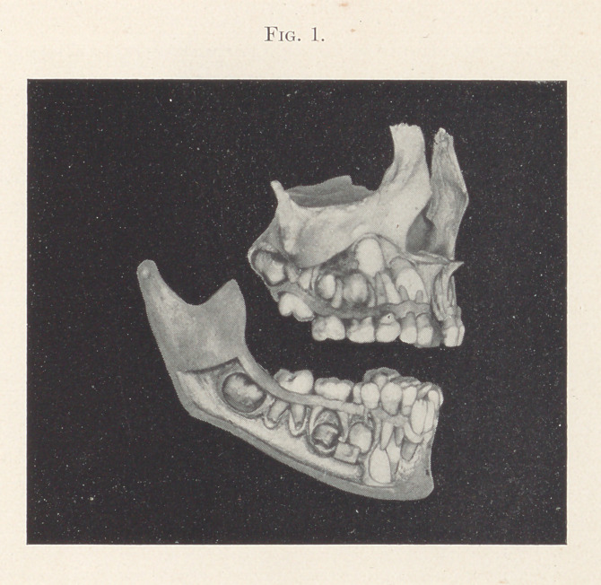 Distal and Mesial Occlusion: Some Causes and Some Results.