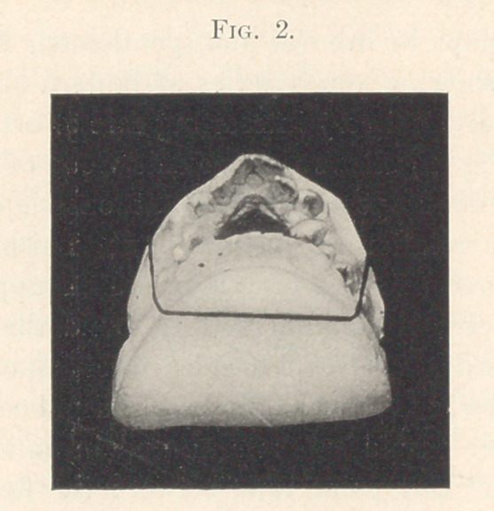 A Report of an Unusual Case of Orthodontia.