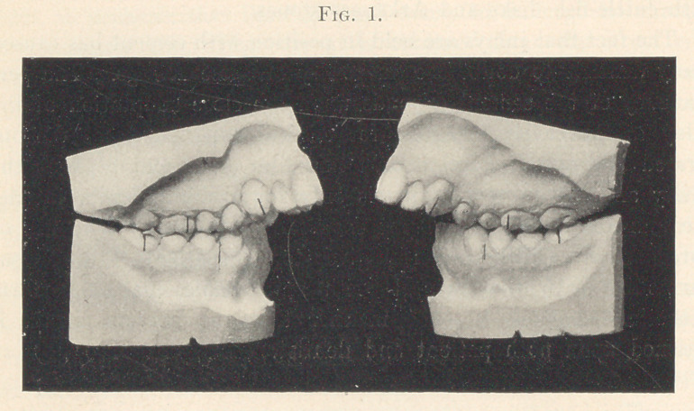 A Report of an Unusual Case of Orthodontia.