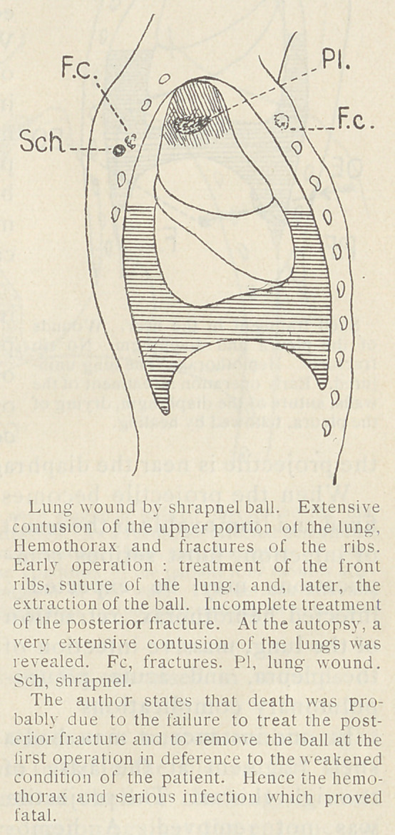 Wounds of the Pleura and of the Lung by Projectiles.