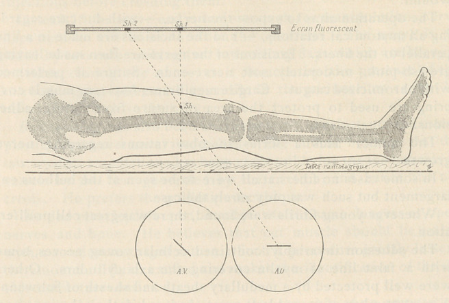 Method of Localization and Extraction of Projectiles by the Simultaneous Use of Two X-Ray Tubes.