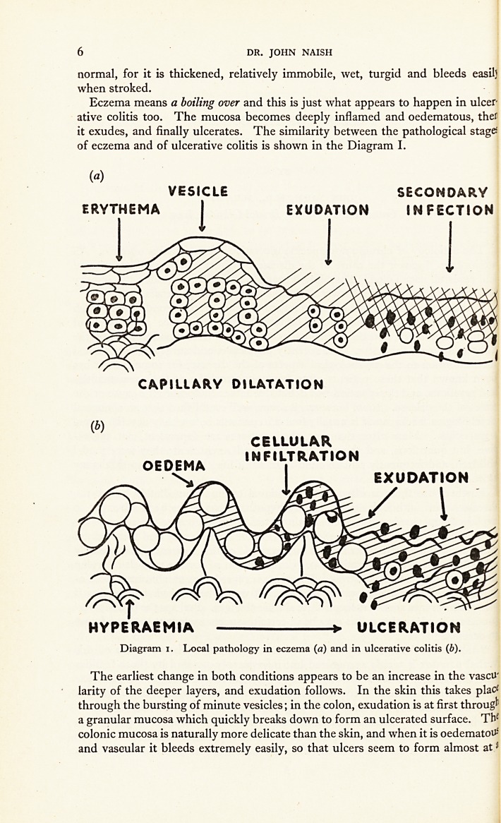 Eczema of the Colon: A New Conception of Ulcerative Colitis.