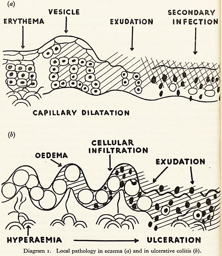 Eczema of the Colon: A New Conception of Ulcerative Colitis.
