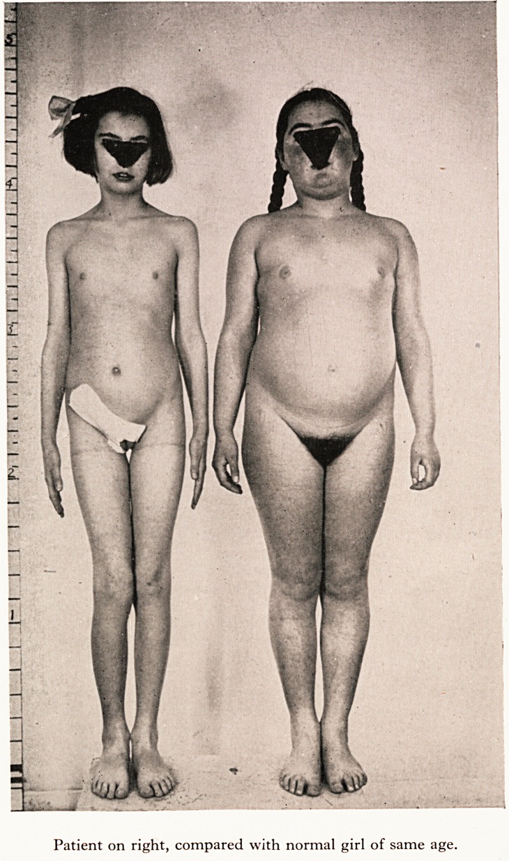 Unexplained Pyrexia in a Child: Clinico-Pathological Report.