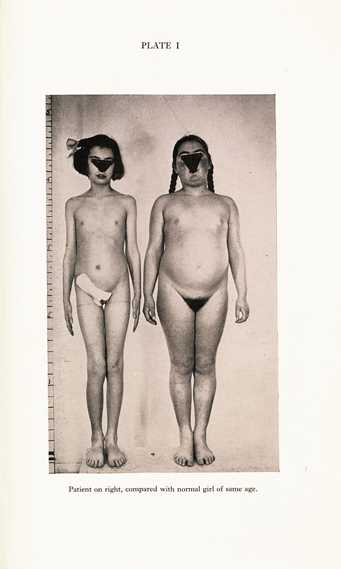 Unexplained Pyrexia in a Child: Clinico-Pathological Report.