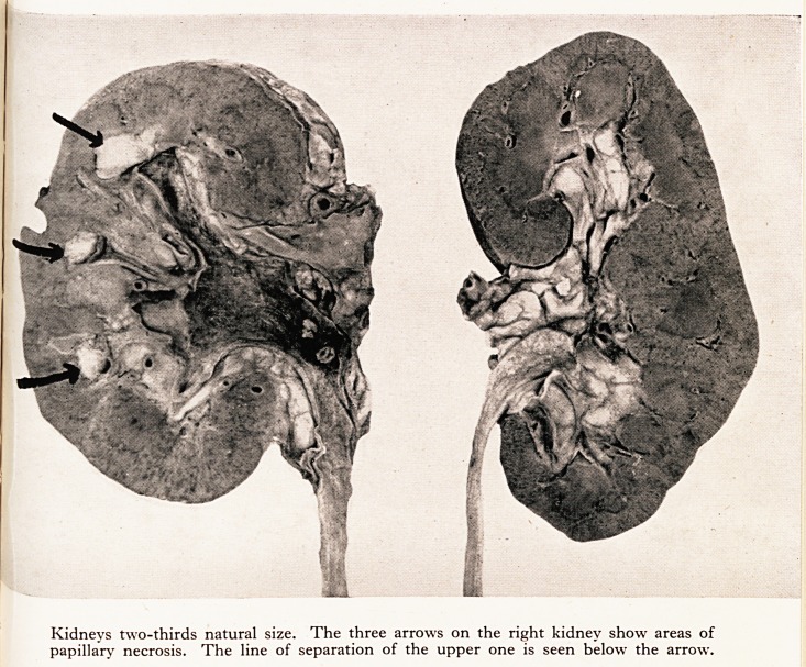 Unilateral Papillary Necrosis of Kidney in a Diabetic : A Rare Complication of Enlargement of the Prostate Gland.