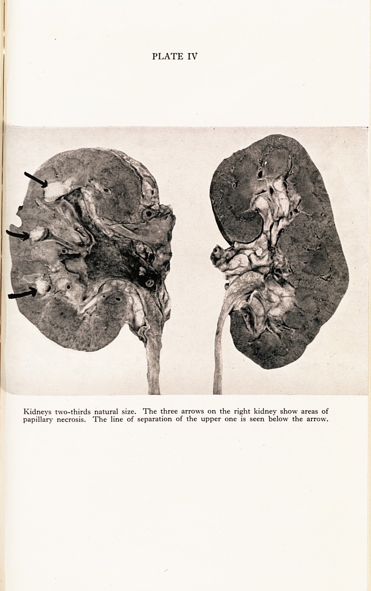 Unilateral Papillary Necrosis of Kidney in a Diabetic : A Rare Complication of Enlargement of the Prostate Gland.