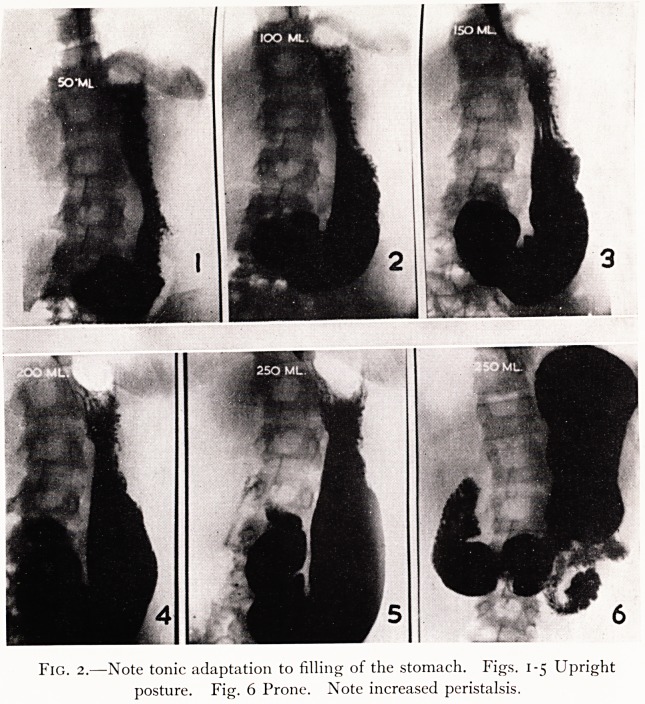 Some phenomena of tone in the gastro-intestinal tract.