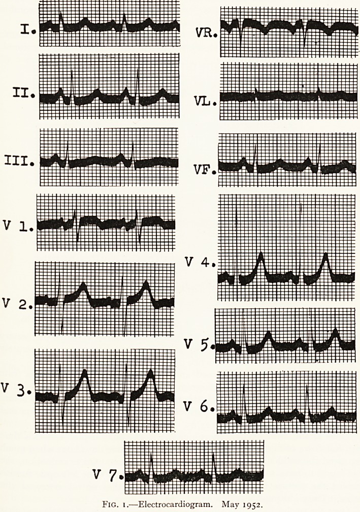 Benign polypoid tumours of the left auricle.