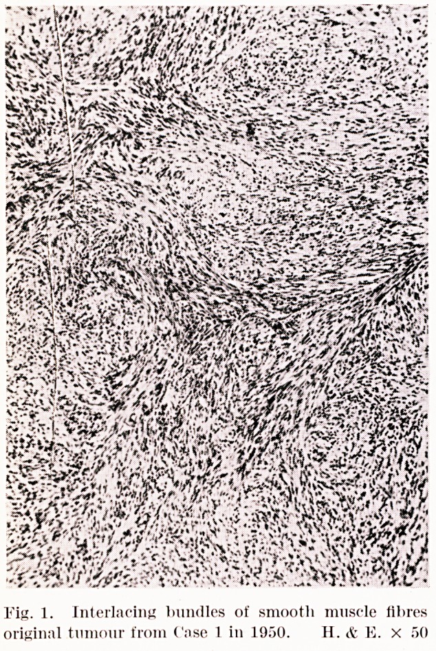 Cutaneous leiomyosarcoma with lymphatic spread:  a report of two cases.