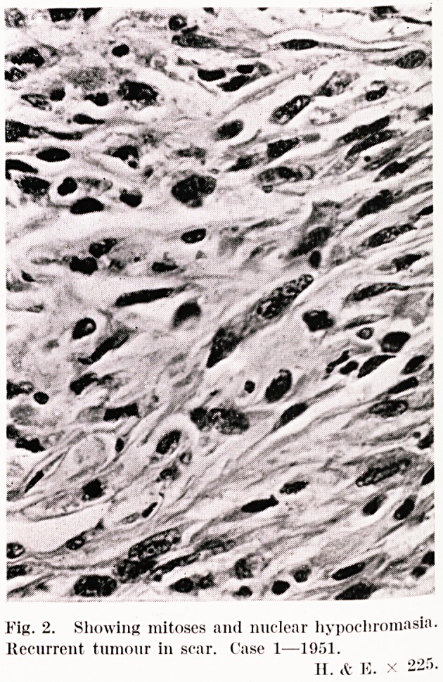 Cutaneous leiomyosarcoma with lymphatic spread:  a report of two cases.