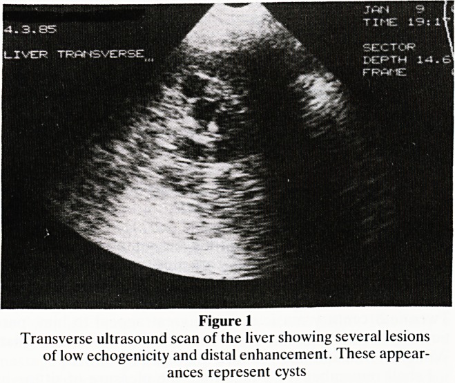 Salutary lesson in interpretation of liver palpation at laparotomy for sigmoid carcinoma.