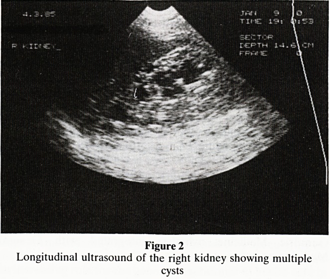 Salutary lesson in interpretation of liver palpation at laparotomy for sigmoid carcinoma.