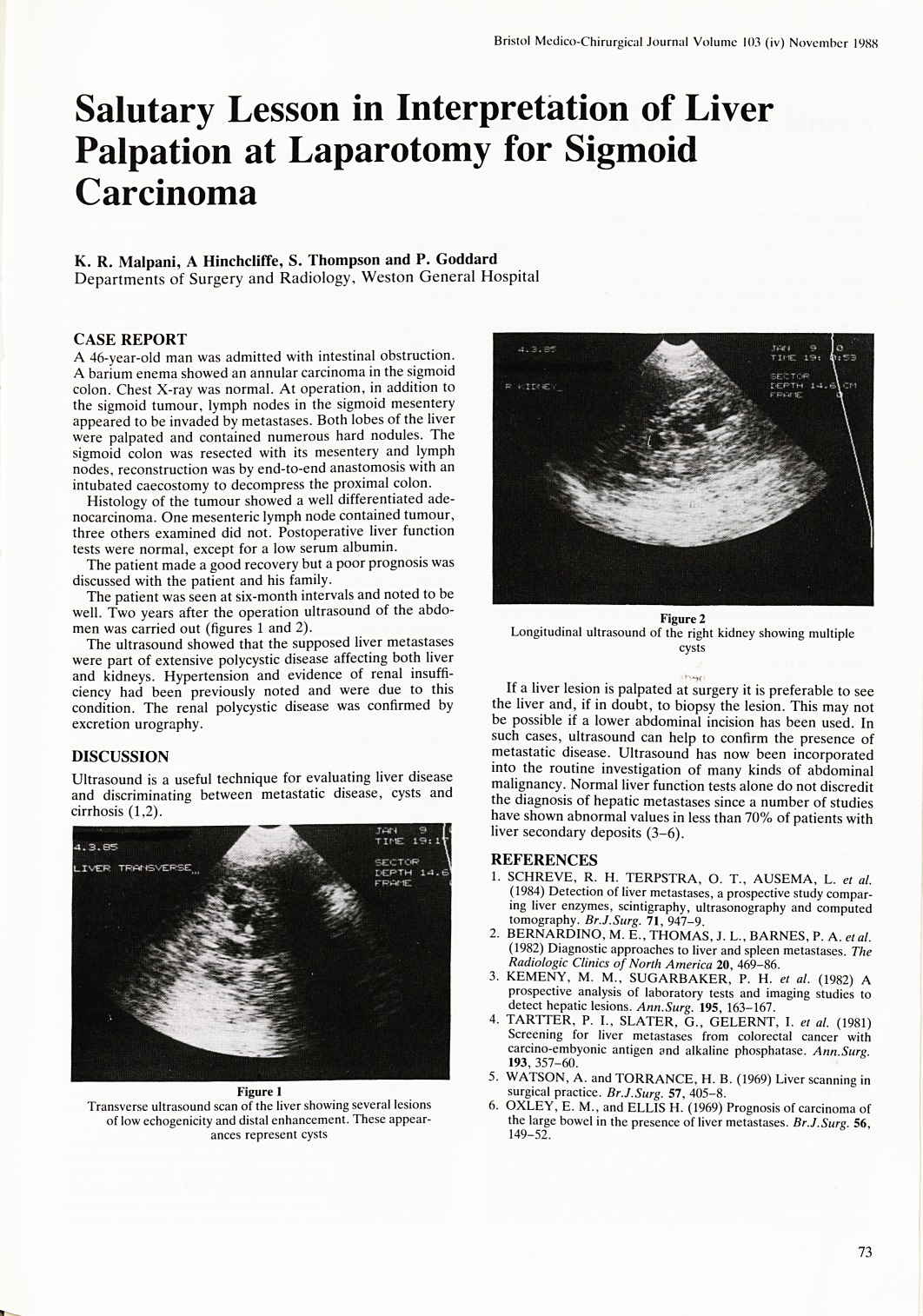 Salutary lesson in interpretation of liver palpation at laparotomy for sigmoid carcinoma.