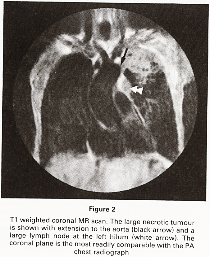 MRI in thoracic malignancy.