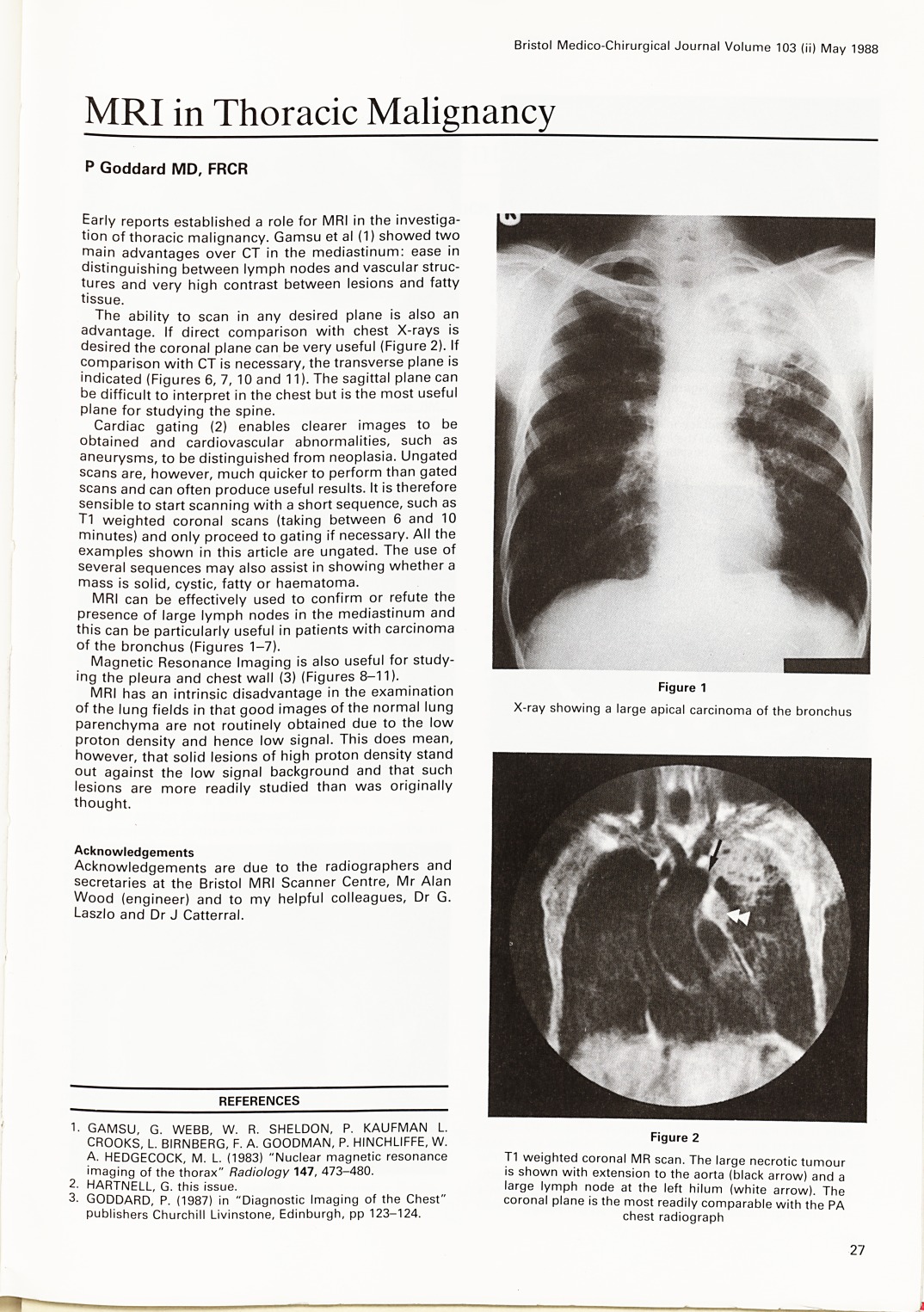 MRI in thoracic malignancy.