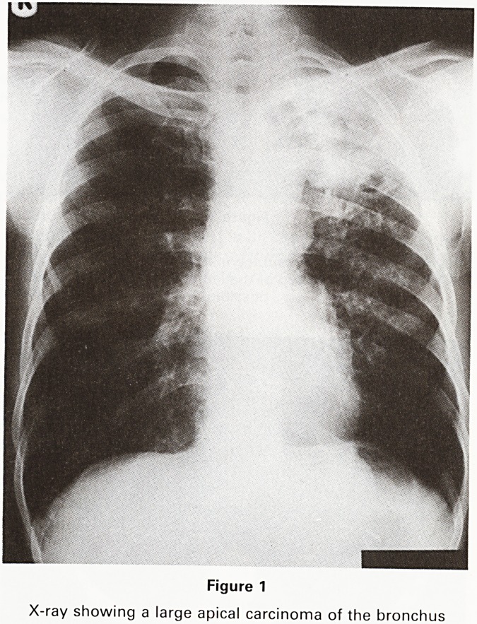 MRI in thoracic malignancy.