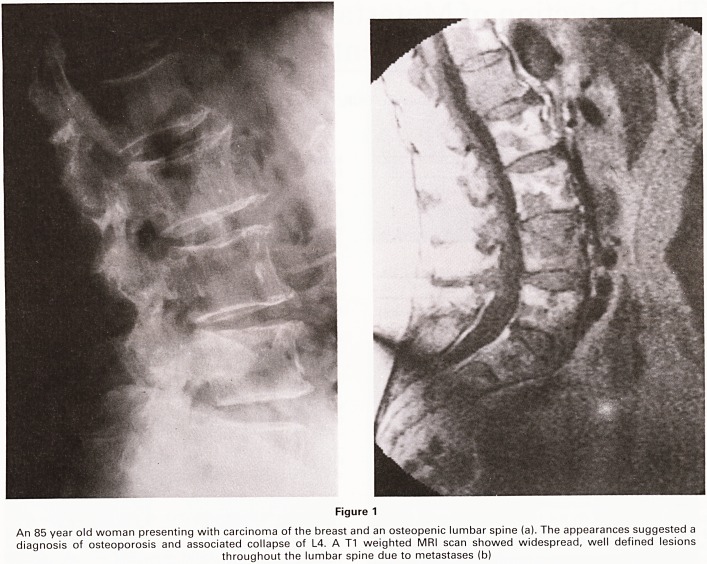 The detection of metastatic disease of the spine in oncology patients using MRI.