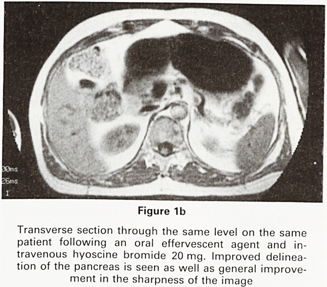 Magnetic resonance imaging of the pancreas.