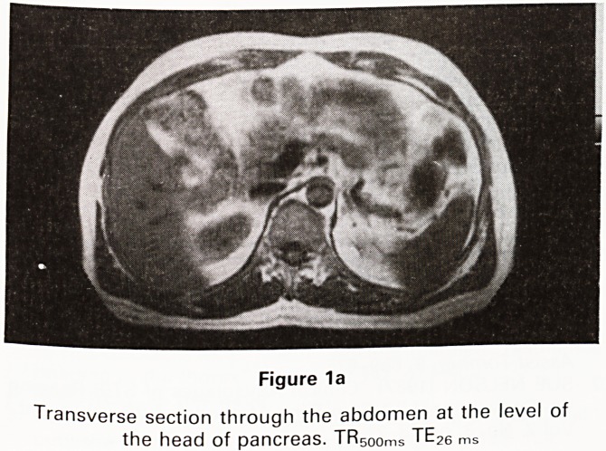 Magnetic resonance imaging of the pancreas.