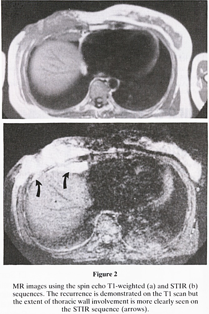 Magnetic resonance imaging and carcinoma of the breast.