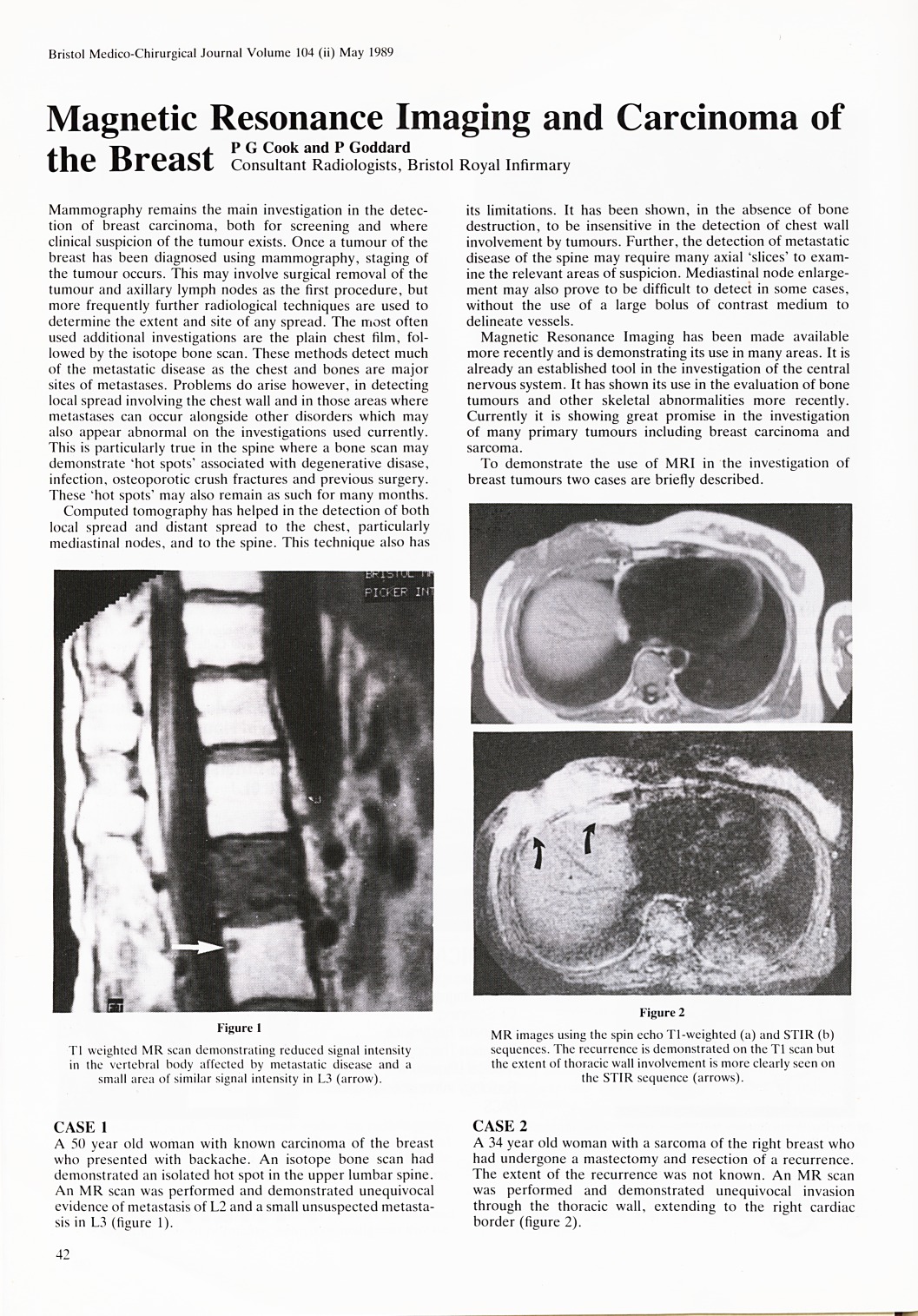 Magnetic resonance imaging and carcinoma of the breast.