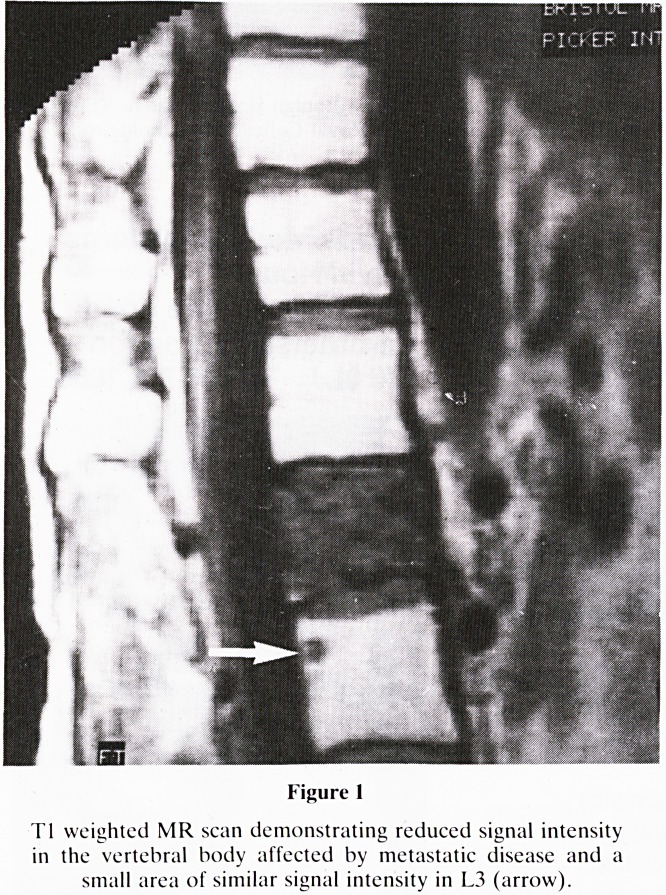 Magnetic resonance imaging and carcinoma of the breast.