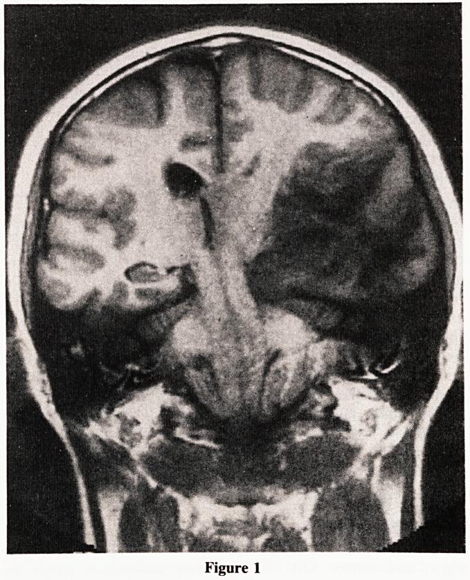Imaging of intracranial tumours--comparison of computed tomography and magnetic resonance imaging.