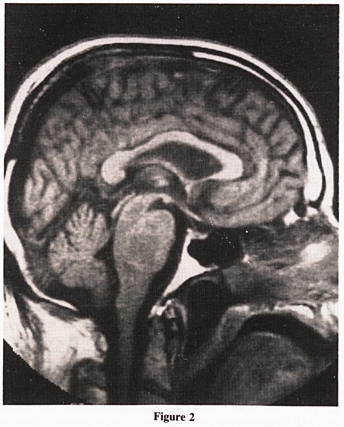 Imaging of intracranial tumours--comparison of computed tomography and magnetic resonance imaging.