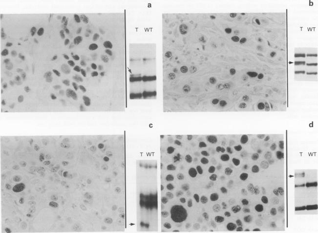 p53 immunohistochemical analysis in breast cancer with four monoclonal antibodies: comparison of staining and PCR-SSCP results