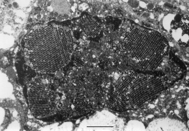Enteric viruses in HIV-related diarrhoea