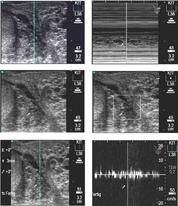 Animated documentation of the filaria dance sign (FDS) in bancroftian filariasis.