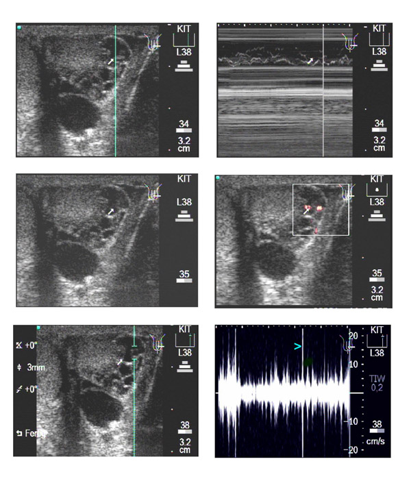 Animated documentation of the filaria dance sign (FDS) in bancroftian filariasis.