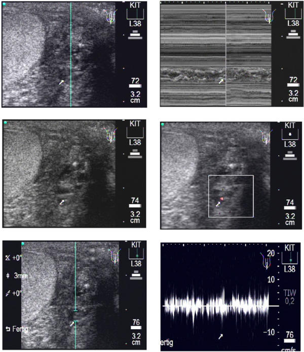 Animated documentation of the filaria dance sign (FDS) in bancroftian filariasis.