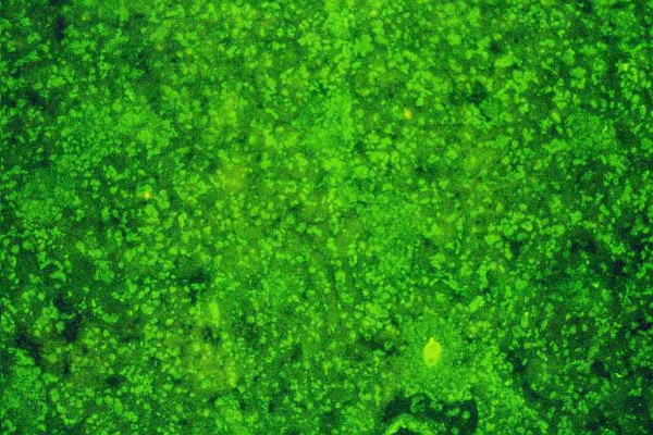 Autoantibodies and autoantigens in autoimmune hepatitis: important tools in clinical practice and to study pathogenesis of the disease.