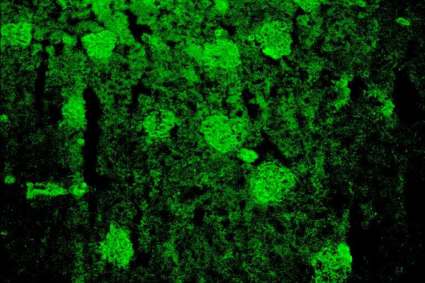 Autoantibodies and autoantigens in autoimmune hepatitis: important tools in clinical practice and to study pathogenesis of the disease.