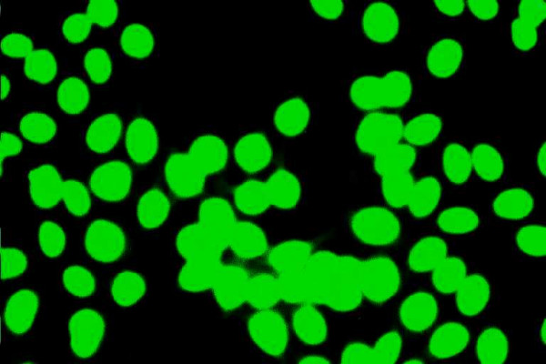 Autoantibodies and autoantigens in autoimmune hepatitis: important tools in clinical practice and to study pathogenesis of the disease.