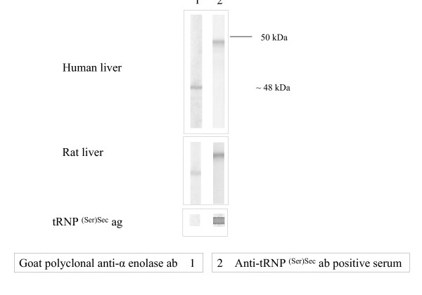 Antibodies to soluble liver antigen and alpha-enolase in patients with autoimmune hepatitis.