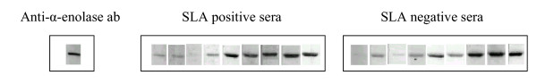 Antibodies to soluble liver antigen and alpha-enolase in patients with autoimmune hepatitis.
