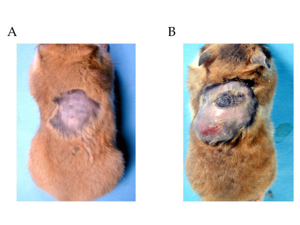 Hyperthermia using magnetite cationic liposomes for hamster osteosarcoma.