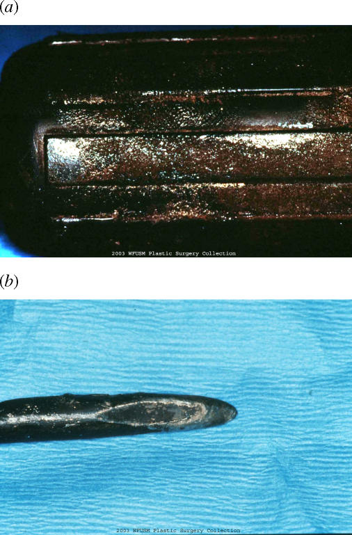 Management of an acute thermal injury with subatmospheric pressure.