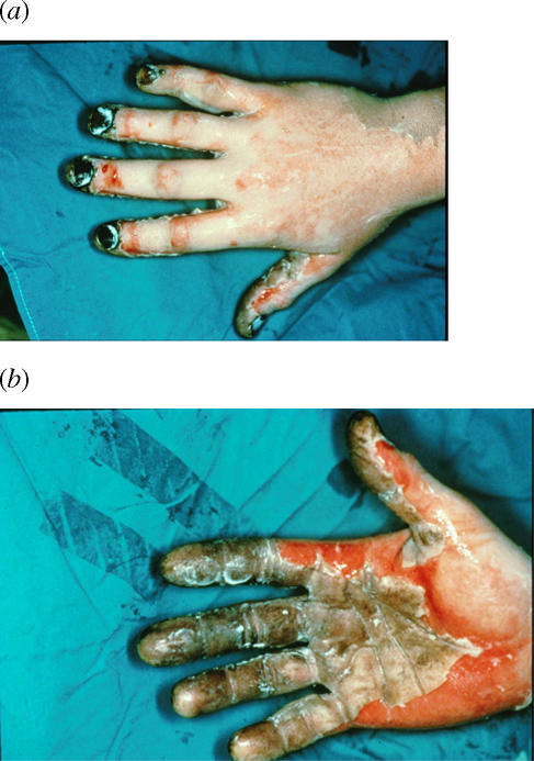 Management of an acute thermal injury with subatmospheric pressure.