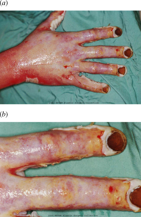 Management of an acute thermal injury with subatmospheric pressure.